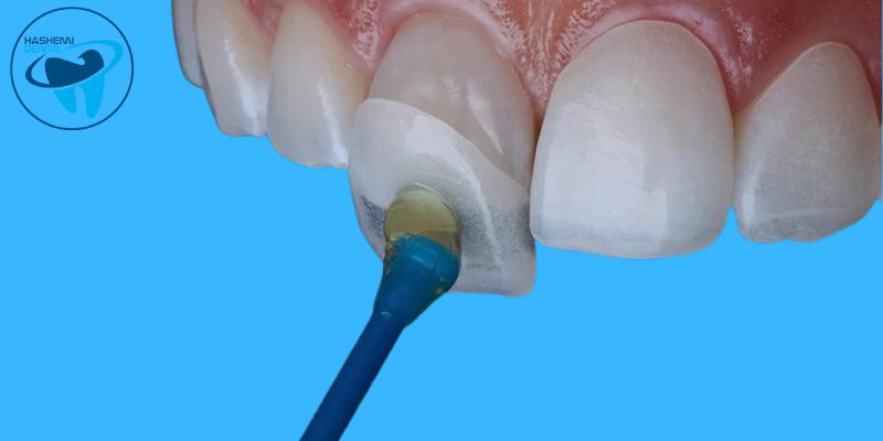 انواع کامپوزیت دندان