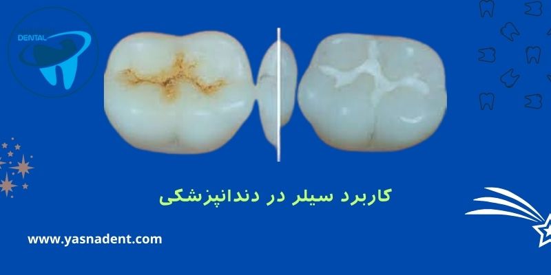 کاربرد سیلر در دندانپزشکی