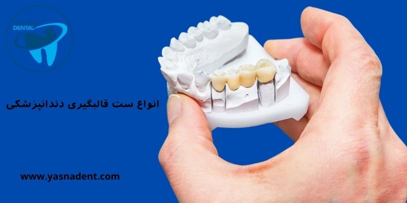 انواع ست قالبگیری دندانپزشکی