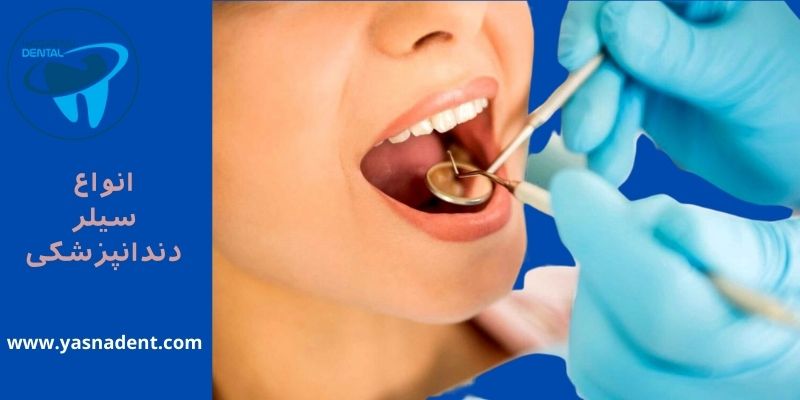 انواع سیلر دندانپزشکی