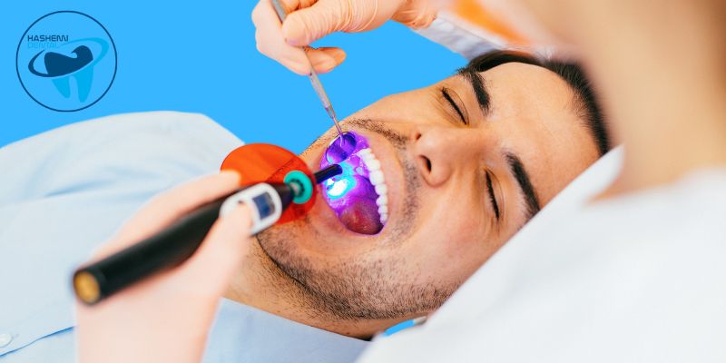 لایت کیور دندانپزشکی چیست؟