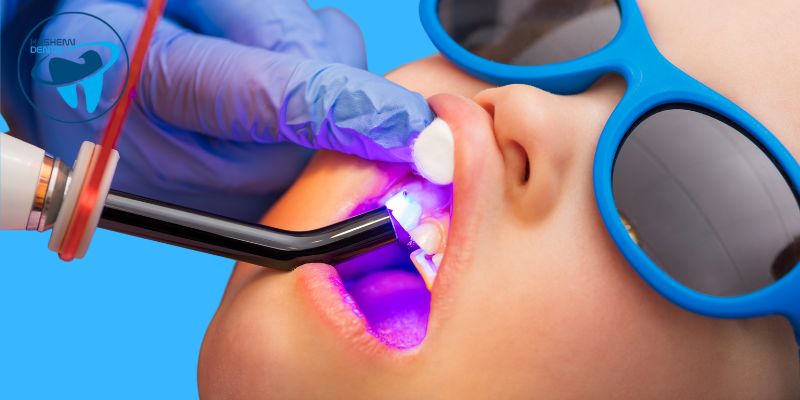 نحوه عملکرد لایت کیور دندانپزشکی