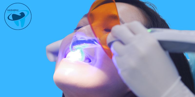 چگونه از لایت کیور دندانپزشکی استفاده می شود؟