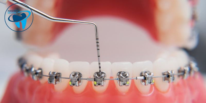 ارتودنسی دندان چقدر طول میکشد؟
