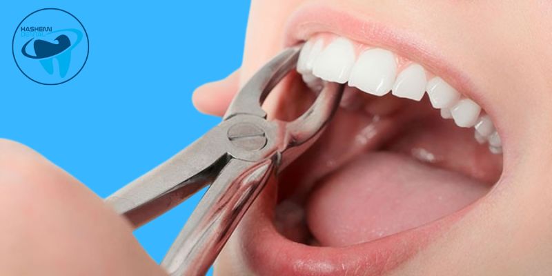 جنس فورسپس دندانپزشکی از چیست؟