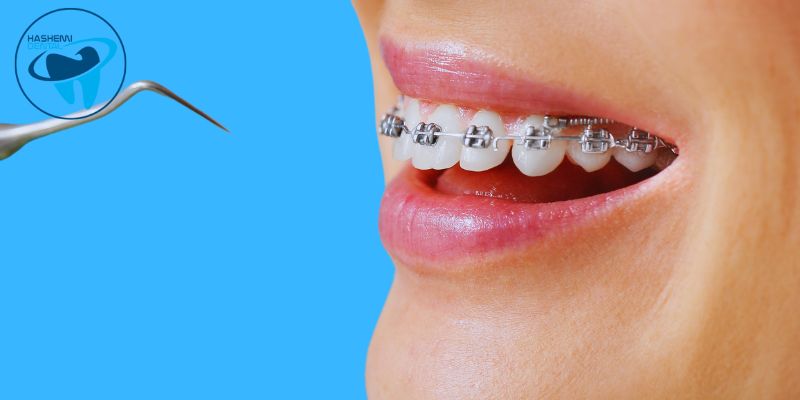 مزایای ارتودنسی دندان