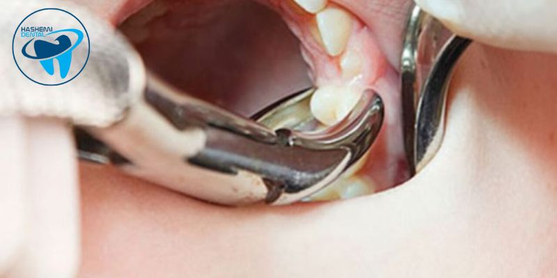 کاربرد فورسپس دندانپزشکی