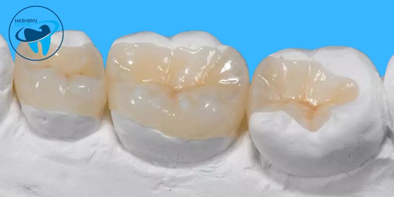 گلاس آینومر دندانپزشکی چیست؟
