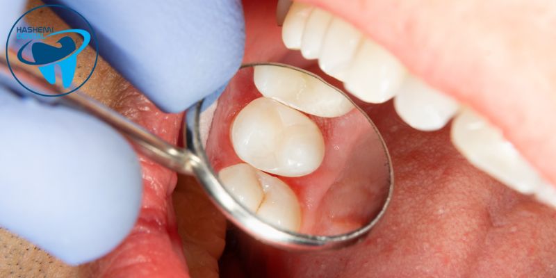 سیلر دندانپزشکی چیست؟