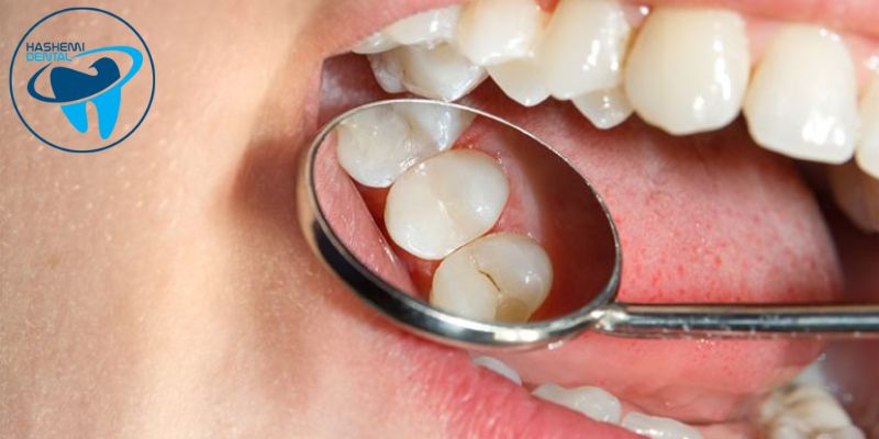 مزایای سیلر دندانپزشکی