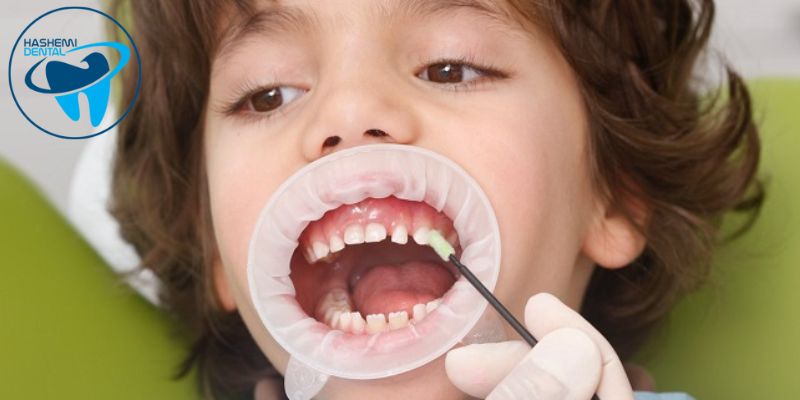 وارنیش فلوراید دندان چیست؟