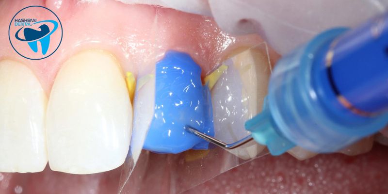 ویژگی اسید اچ دندانپزشکی
