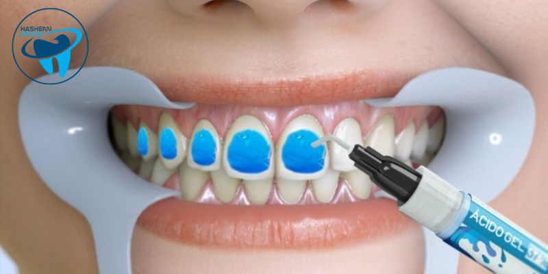 اسید اچ دندانپزشکی چیست؟